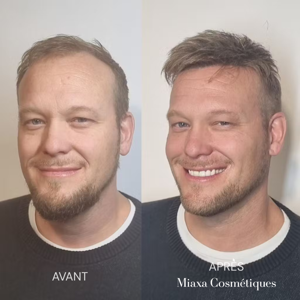 Kit Micro-Infusion Miaxa™ Solution Capillaire