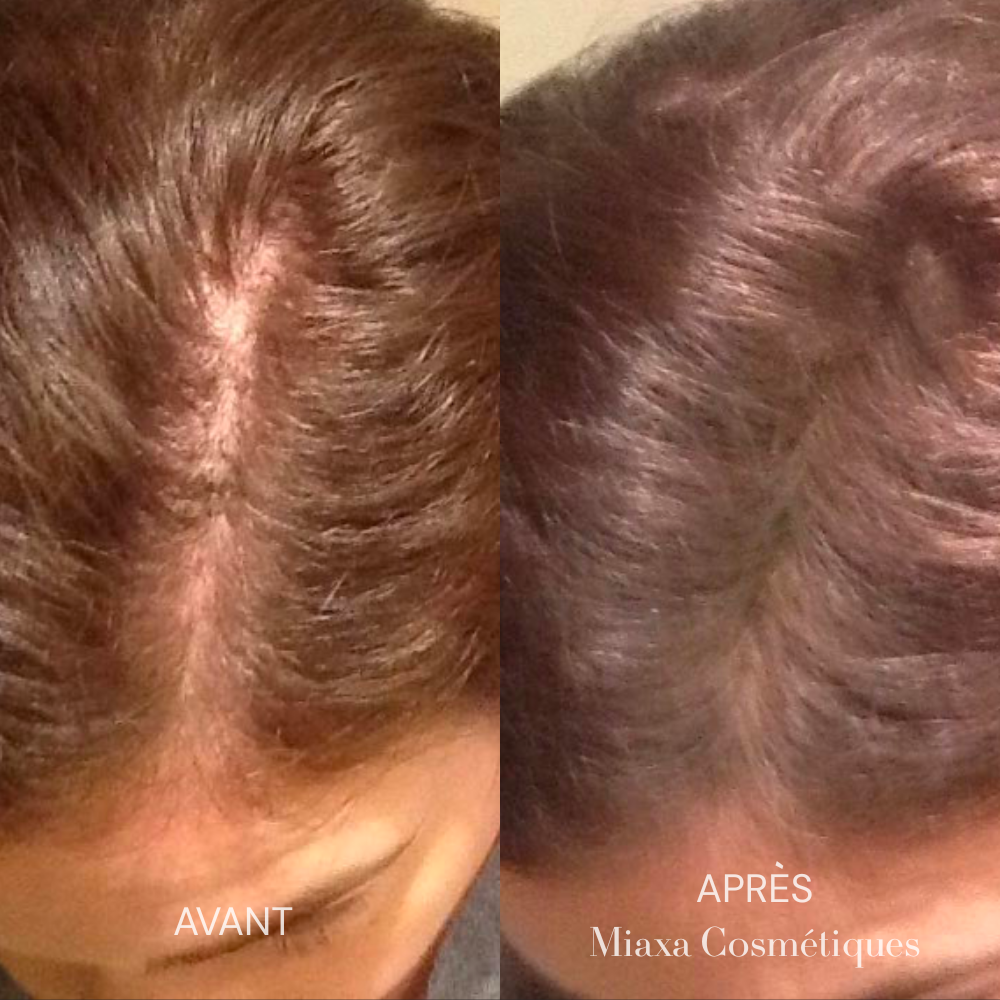 Kit Micro-Infusion Miaxa™ Solution Capillaire