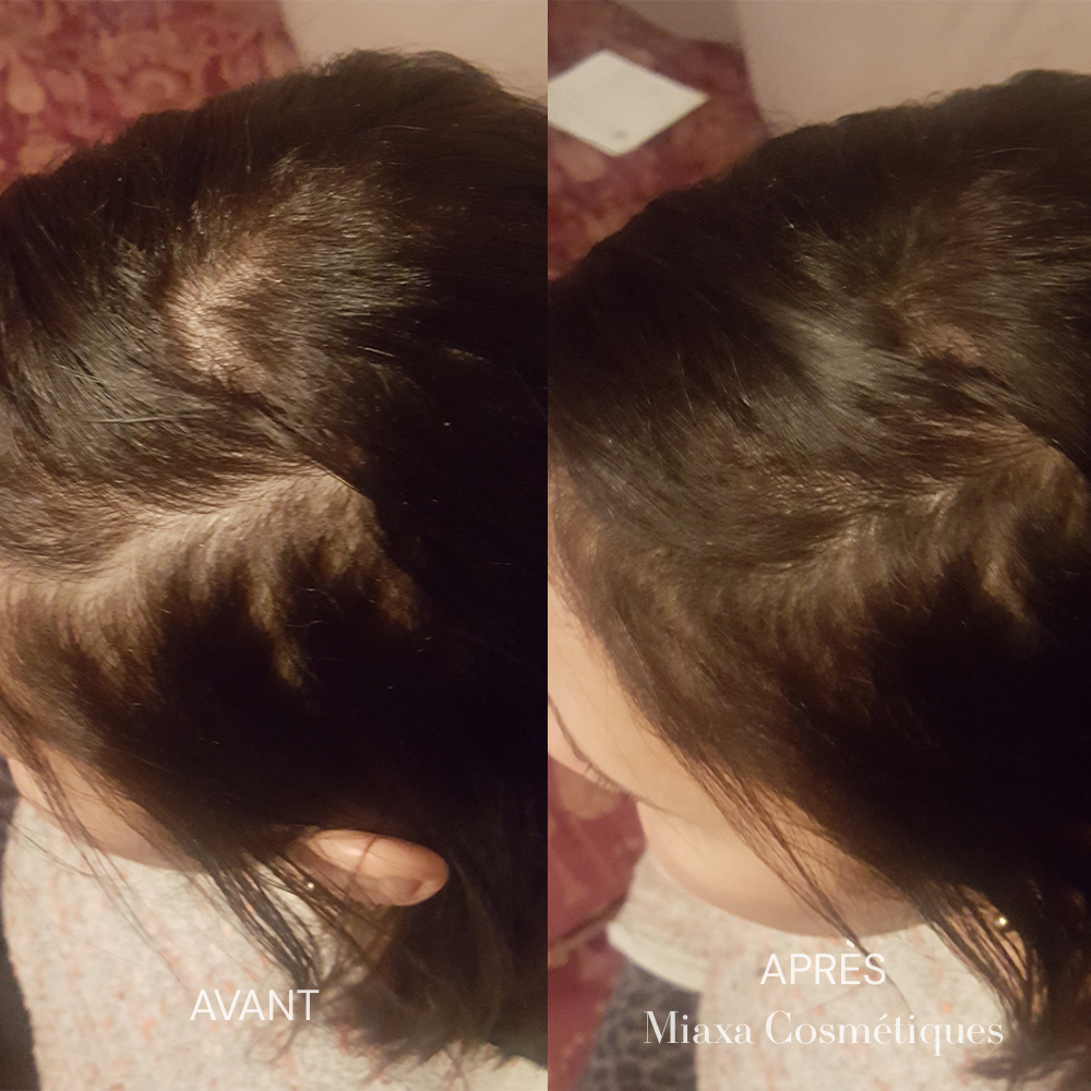 Kit Micro-Infusion Miaxa™ Solution Capillaire