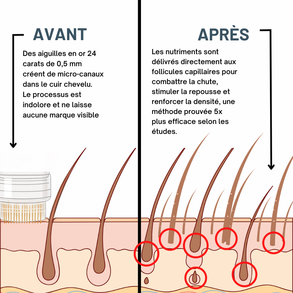 Kit Micro-Infusion Miaxa™ Solution Capillaire