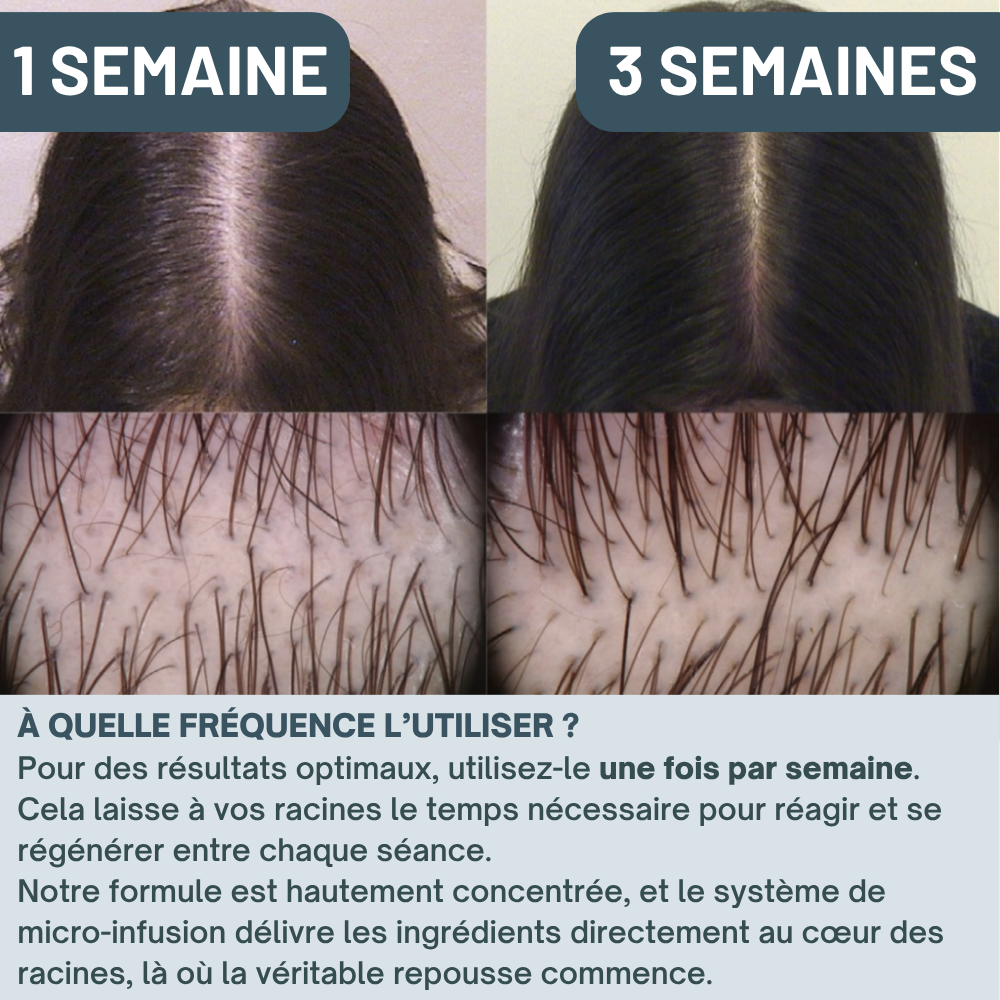Kit Micro-Infusion Miaxa™ Solution Capillaire