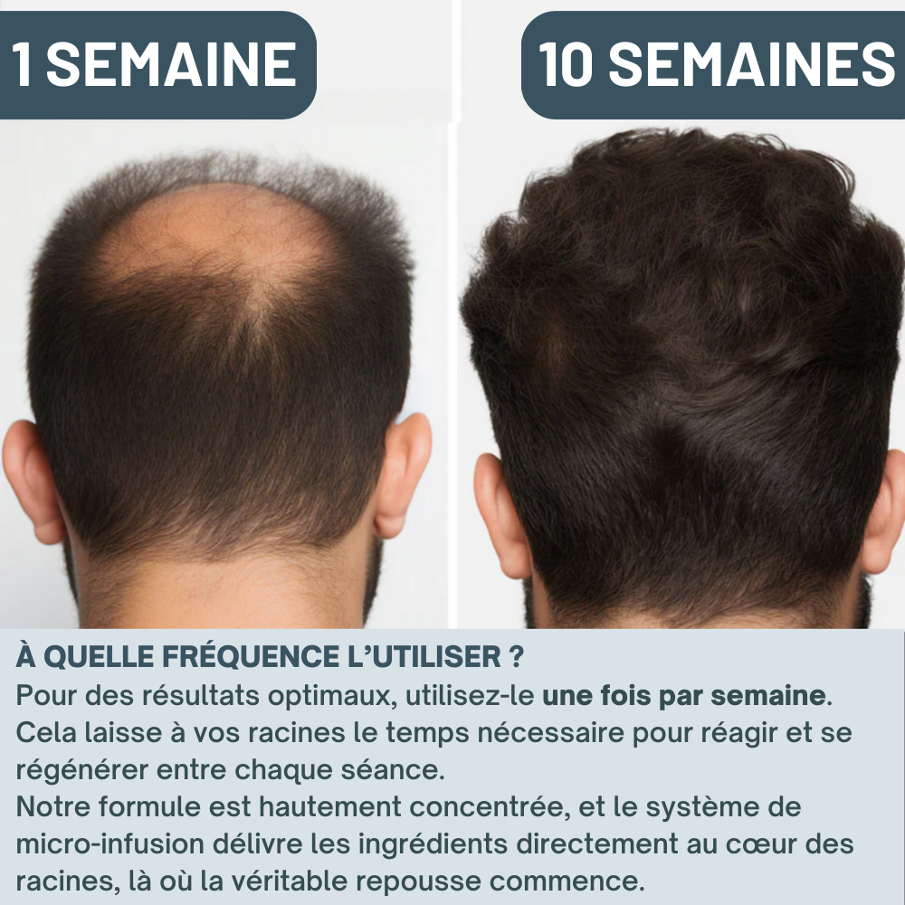 Kit Micro-Infusion Miaxa™ Solution Capillaire