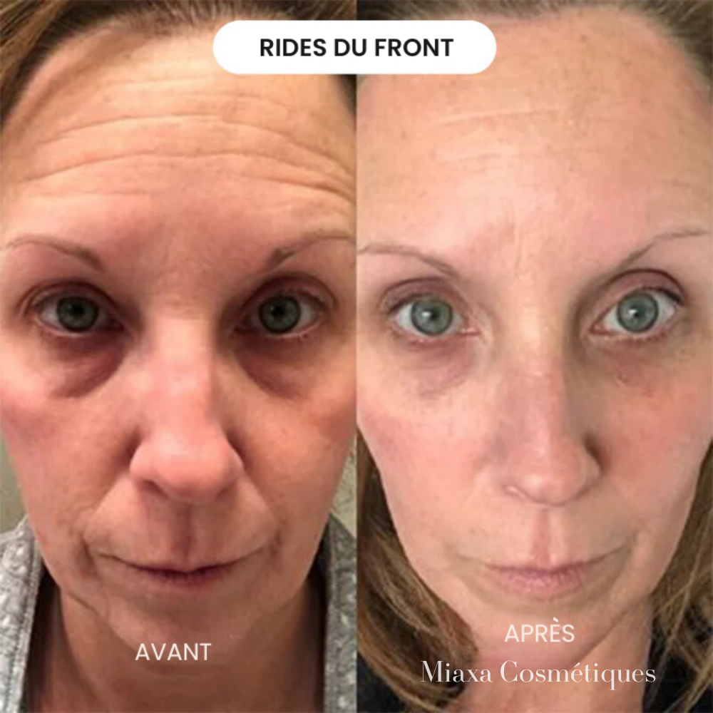 Kit Micro-Infusion Miaxa™ Solution Anti-Âge