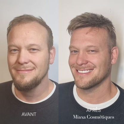 Kit Micro-Infusion Miaxa™ Solution Capillaire