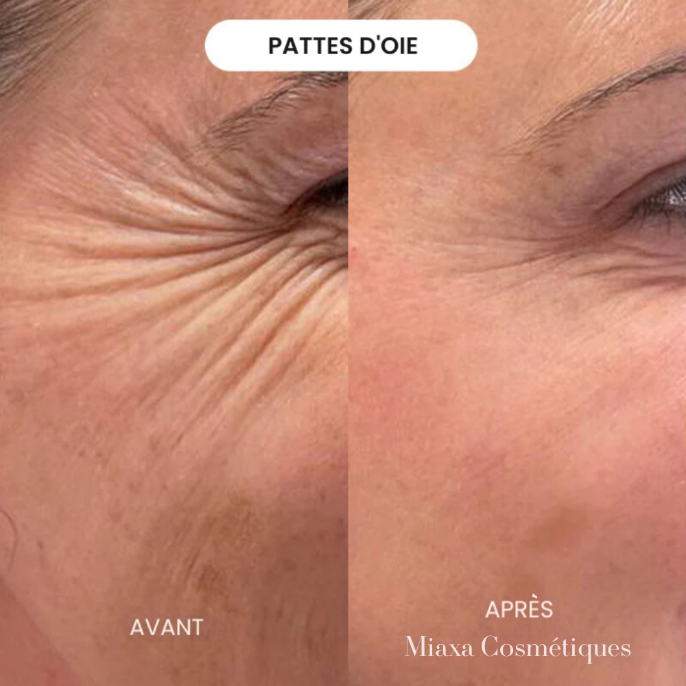 Kit Micro-Infusion Miaxa™ Solution Anti-Âge