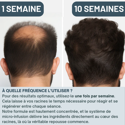 Kit Micro-Infusion Miaxa™ Solution Capillaire