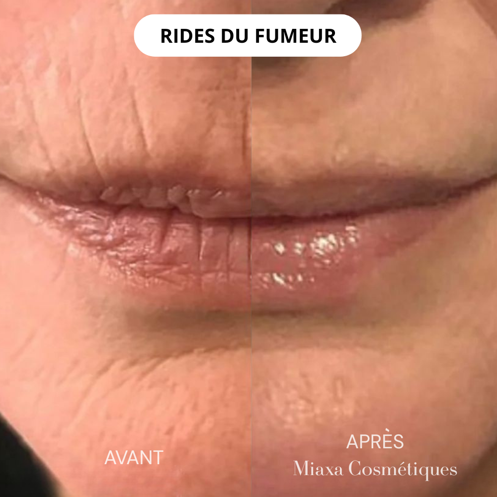 Kit Micro-Infusion Miaxa™ Solution Anti-Âge